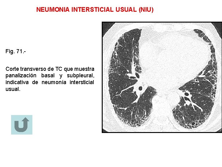 NEUMONIA INTERSTICIAL USUAL (NIU) Fig. 71. Corte transverso de TC que muestra panalización basal