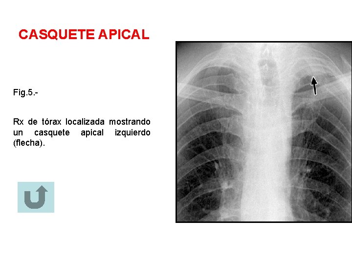 CASQUETE APICAL Fig. 5. Rx de tórax localizada mostrando un casquete apical izquierdo (flecha).