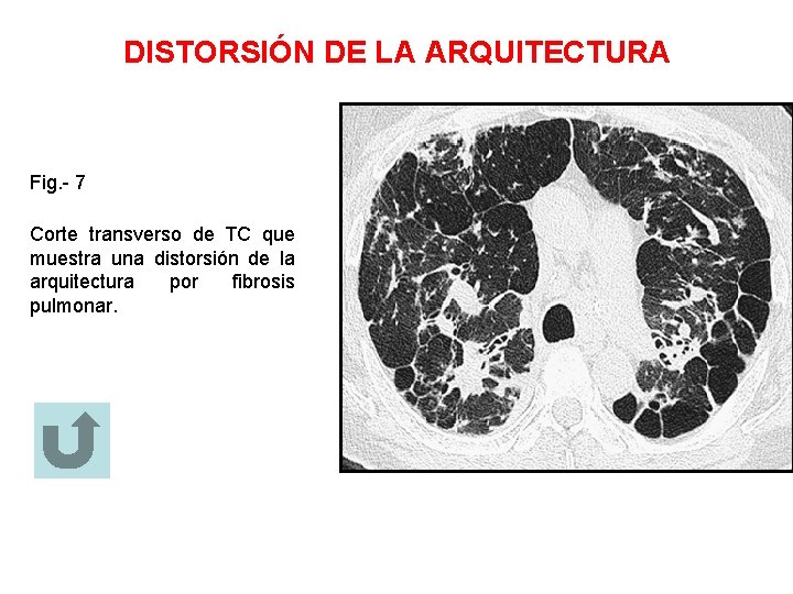 DISTORSIÓN DE LA ARQUITECTURA Fig. - 7 Corte transverso de TC que muestra una