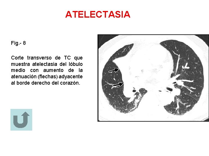 ATELECTASIA Fig. - 8 Corte transverso de TC que muestra atelectasia del lóbulo medio