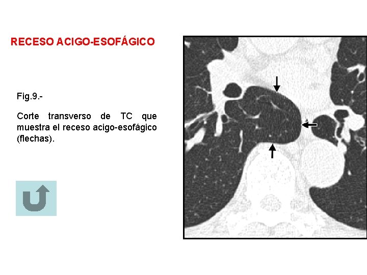 RECESO ACIGO-ESOFÁGICO Fig. 9. Corte transverso de TC que muestra el receso acigo-esofágico (flechas).