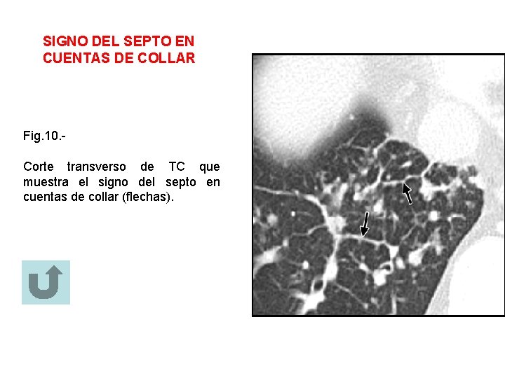 SIGNO DEL SEPTO EN CUENTAS DE COLLAR Fig. 10. Corte transverso de TC que