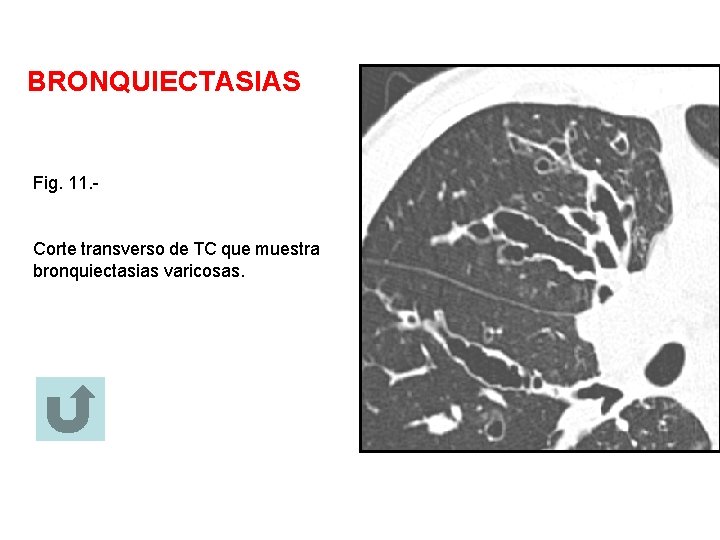 BRONQUIECTASIAS Fig. 11. - Corte transverso de TC que muestra bronquiectasias varicosas. 