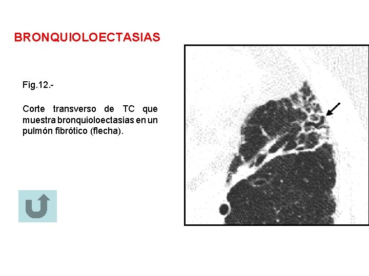 BRONQUIOLOECTASIAS Fig. 12. Corte transverso de TC que muestra bronquioloectasias en un pulmón fibrótico