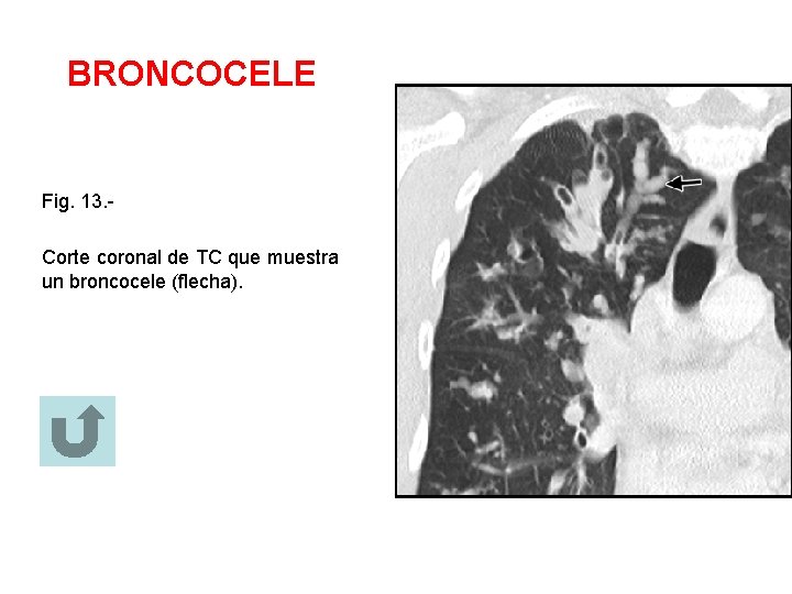 BRONCOCELE Fig. 13. Corte coronal de TC que muestra un broncocele (flecha). 