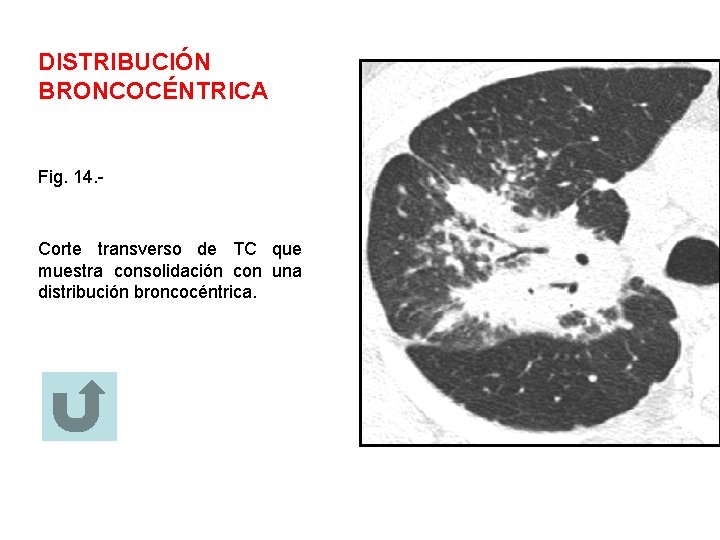 DISTRIBUCIÓN BRONCOCÉNTRICA Fig. 14. - Corte transverso de TC que muestra consolidación con una