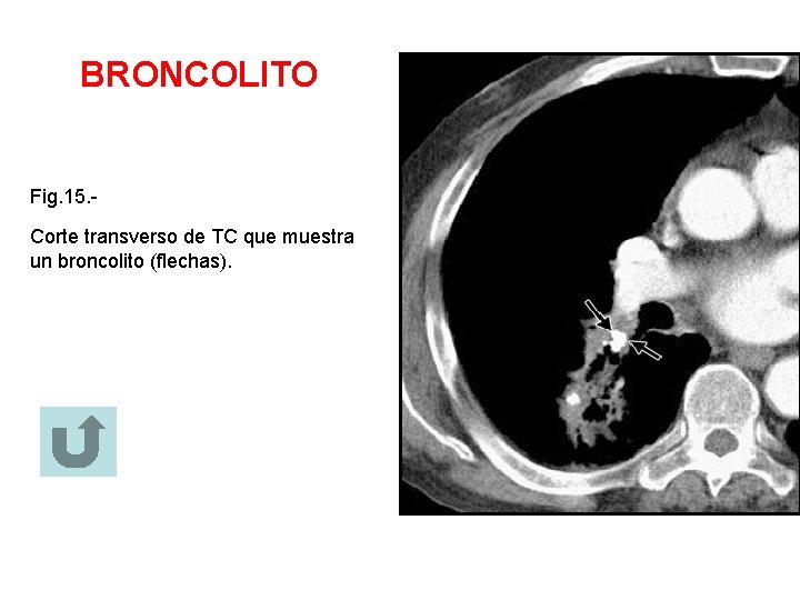 BRONCOLITO Fig. 15. Corte transverso de TC que muestra un broncolito (flechas). 