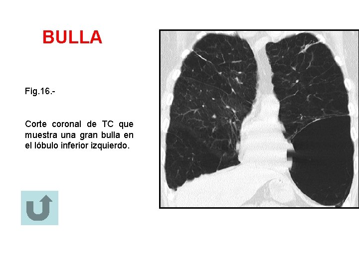 BULLA Fig. 16. - Corte coronal de TC que muestra una gran bulla en