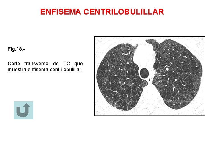 ENFISEMA CENTRILOBULILLAR Fig. 18. Corte transverso de TC que muestra enfisema centrilobulillar. 