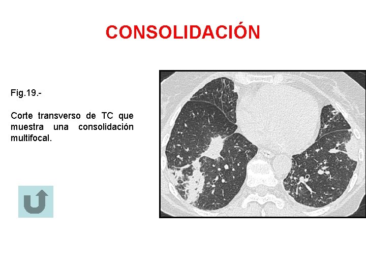 CONSOLIDACIÓN Fig. 19. Corte transverso de TC que muestra una consolidación multifocal. 