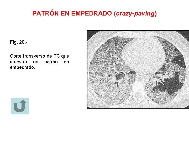 PATRÓN EN EMPEDRADO (crazy-paving) Fig. 20. Corte transverso de TC que muestra un patrón