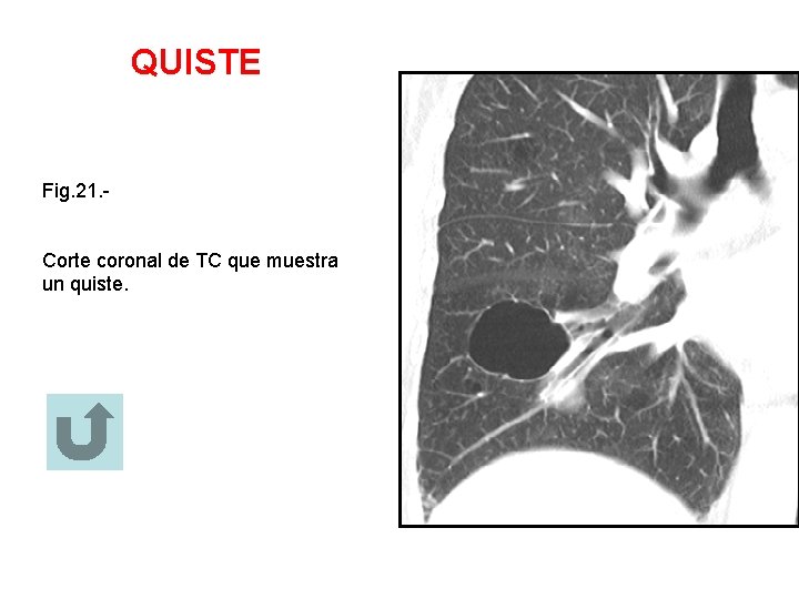 QUISTE Fig. 21. Corte coronal de TC que muestra un quiste. 