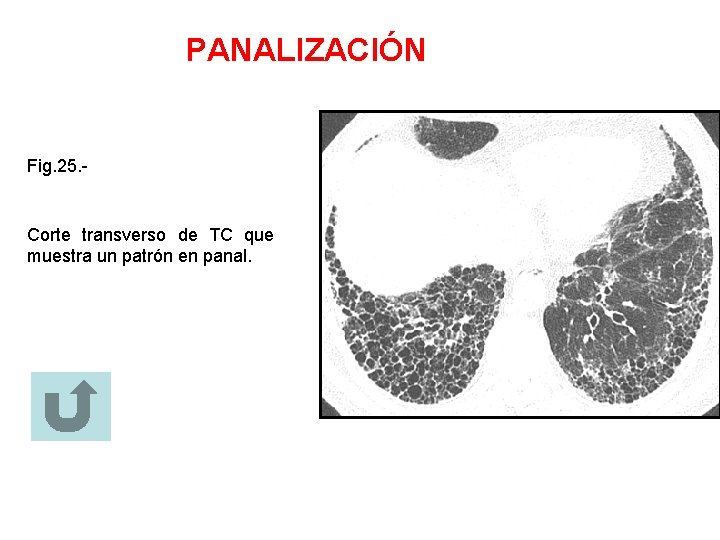 PANALIZACIÓN Fig. 25. - Corte transverso de TC que muestra un patrón en panal.