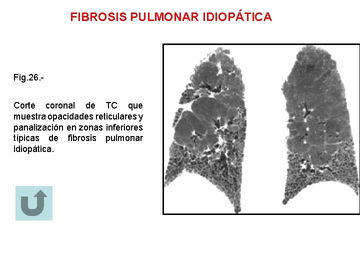 FIBROSIS PULMONAR IDIOPÁTICA Fig. 26. Corte coronal de TC que muestra opacidades reticulares y