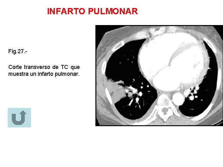 INFARTO PULMONAR Fig. 27. Corte transverso de TC que muestra un infarto pulmonar. 