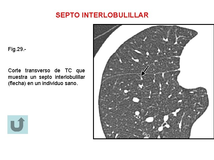 SEPTO INTERLOBULILLAR Fig. 29. - Corte transverso de TC que muestra un septo interlobulillar