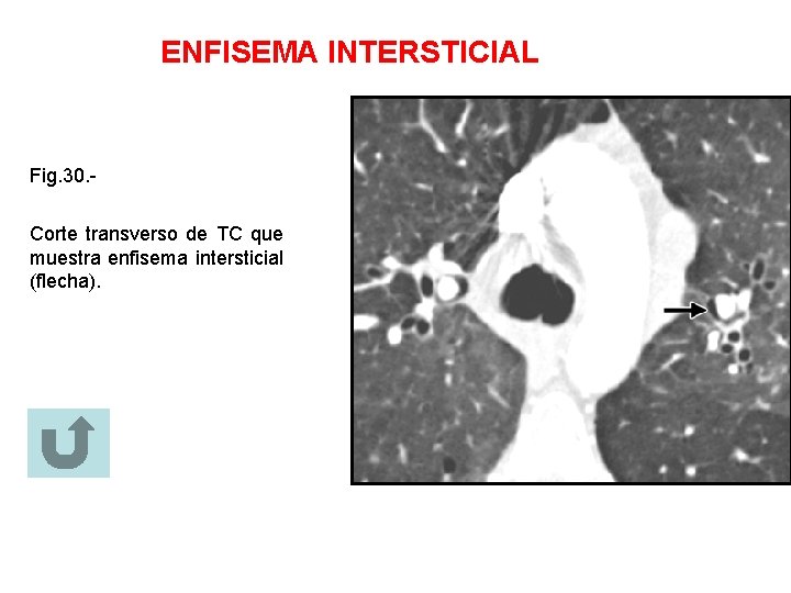 ENFISEMA INTERSTICIAL Fig. 30. Corte transverso de TC que muestra enfisema intersticial (flecha). 