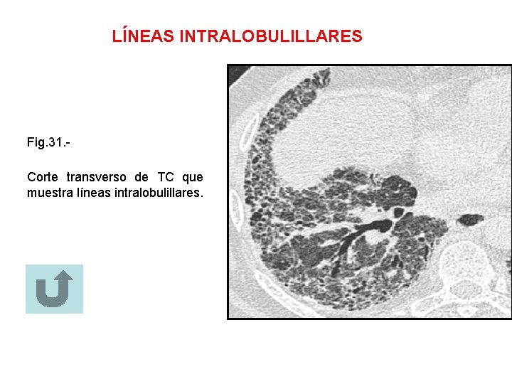 LÍNEAS INTRALOBULILLARES Fig. 31. Corte transverso de TC que muestra líneas intralobulillares. 