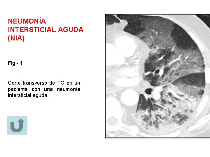 NEUMONÍA INTERSTICIAL AGUDA (NIA) Fig. - 1 Corte transverso de TC en un paciente