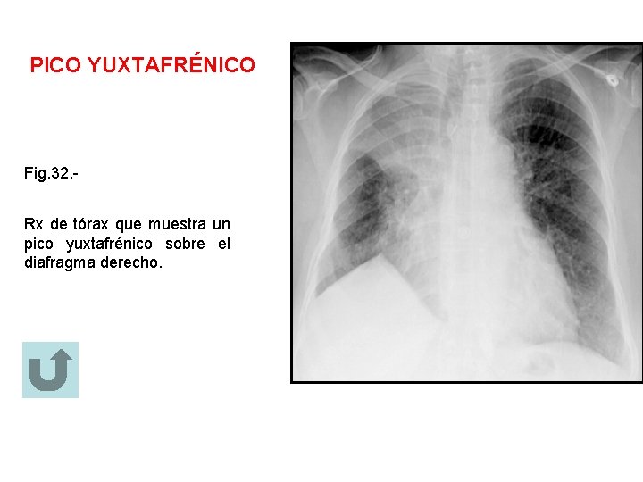 PICO YUXTAFRÉNICO Fig. 32. Rx de tórax que muestra un pico yuxtafrénico sobre el