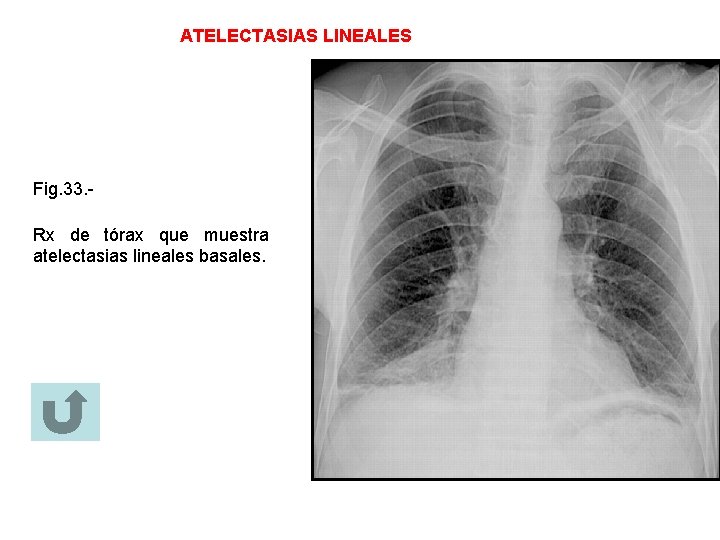 ATELECTASIAS LINEALES Fig. 33. Rx de tórax que muestra atelectasias lineales basales. 