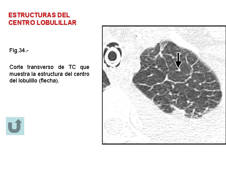 ESTRUCTURAS DEL CENTRO LOBULILLAR Fig. 34. Corte transverso de TC que muestra la estructura