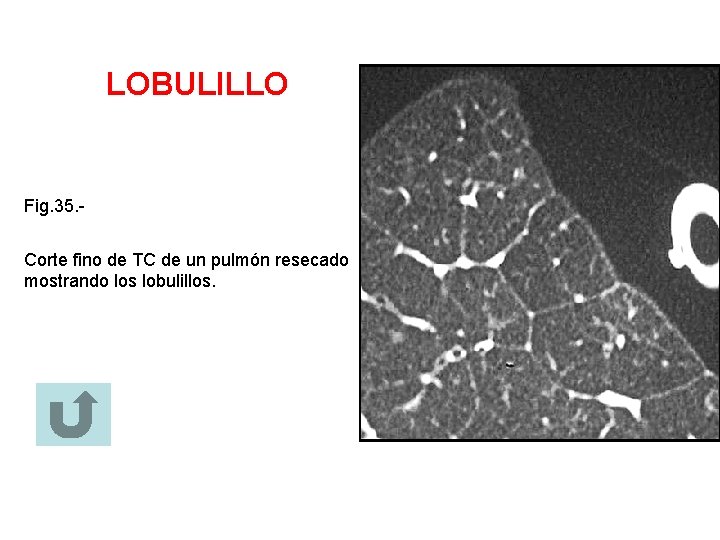 LOBULILLO Fig. 35. Corte fino de TC de un pulmón resecado mostrando los lobulillos.