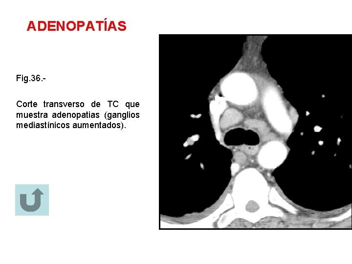 ADENOPATÍAS Fig. 36. Corte transverso de TC que muestra adenopatias (ganglios mediastínicos aumentados). 