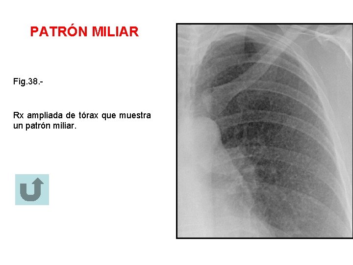 PATRÓN MILIAR Fig. 38. - Rx ampliada de tórax que muestra un patrón miliar.