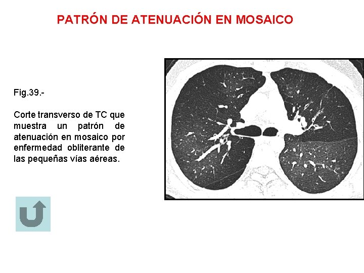 PATRÓN DE ATENUACIÓN EN MOSAICO Fig. 39. Corte transverso de TC que muestra un
