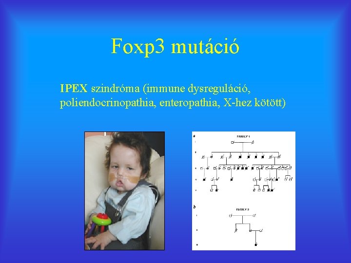 Foxp 3 mutáció IPEX szindróma (immune dysreguláció, poliendocrinopathia, enteropathia, X-hez kötött) 