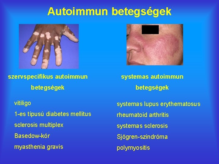 Autoimmun betegségek szervspecifikus autoimmun systemas autoimmun betegségek vitiligo systemas lupus erythematosus 1 -es típusú