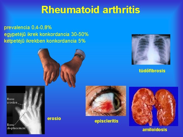 Rheumatoid arthritis prevalencia 0, 4 -0, 8% egypetéjű ikrek konkordancia 30 -50% kétpetéjű ikrekben