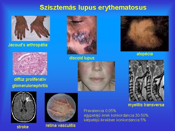 Szisztemás lupus erythematosus Jacoud's arthropátia discoid lupus alopécia diffúz proliferatív glomerulonephritis myelitis transversa Prevalencia