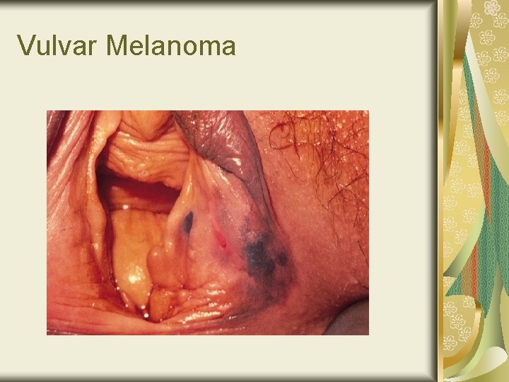 Vulvar Melanoma 