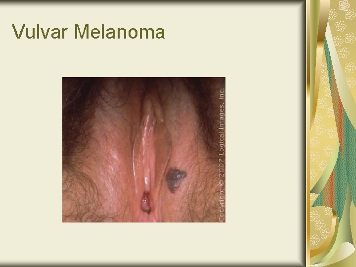 Vulvar Melanoma 