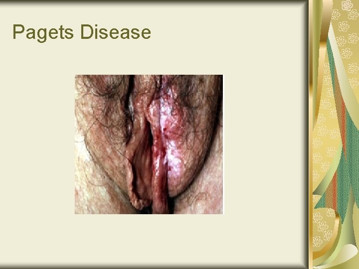 Pagets Disease 