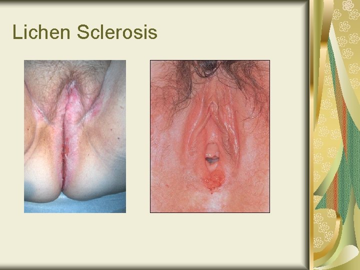 Lichen Sclerosis 