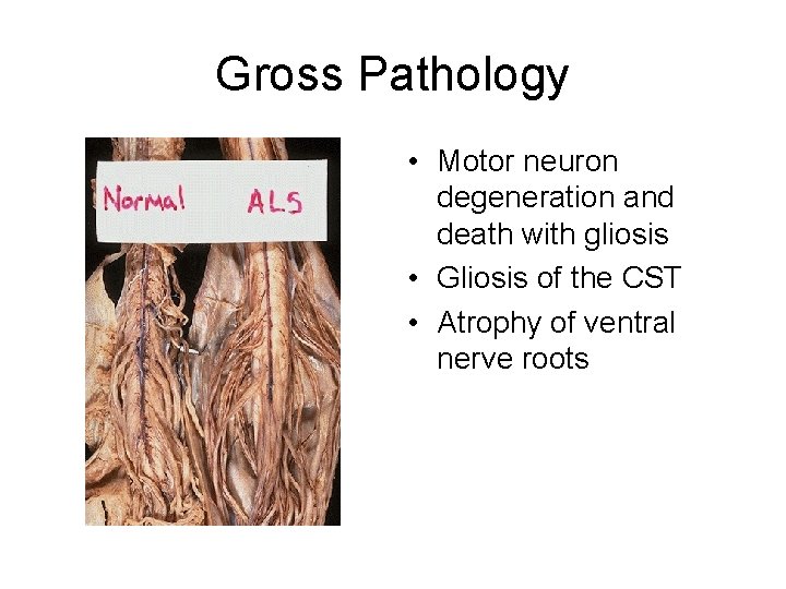 Gross Pathology • Motor neuron degeneration and death with gliosis • Gliosis of the