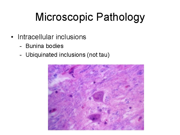 Microscopic Pathology • Intracellular inclusions - Bunina bodies - Ubiquinated inclusions (not tau) 