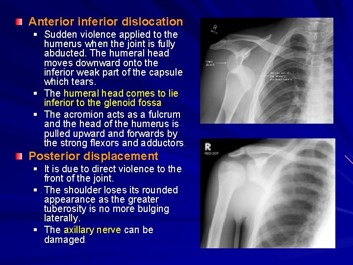 Anterior inferior dislocation § Sudden violence applied to the humerus when the joint is