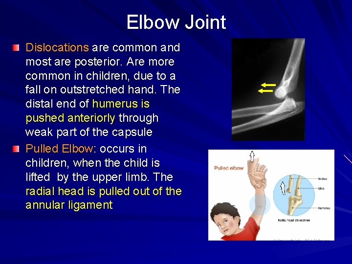 Elbow Joint Dislocations are common and most are posterior. Are more common in children,