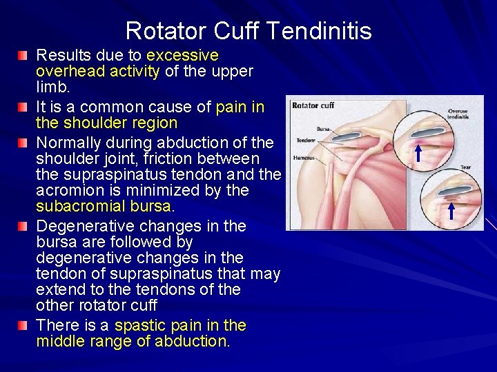 Rotator Cuff Tendinitis Results due to excessive overhead activity of the upper limb. It