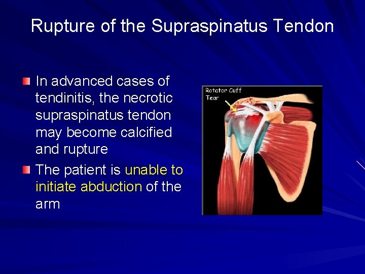 Rupture of the Supraspinatus Tendon In advanced cases of tendinitis, the necrotic supraspinatus tendon