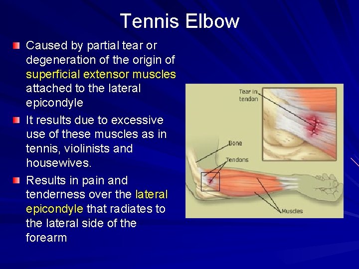 Tennis Elbow Caused by partial tear or degeneration of the origin of superficial extensor
