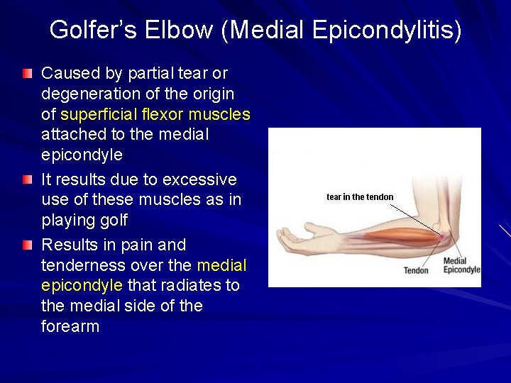 Golfer’s Elbow (Medial Epicondylitis) Caused by partial tear or degeneration of the origin of