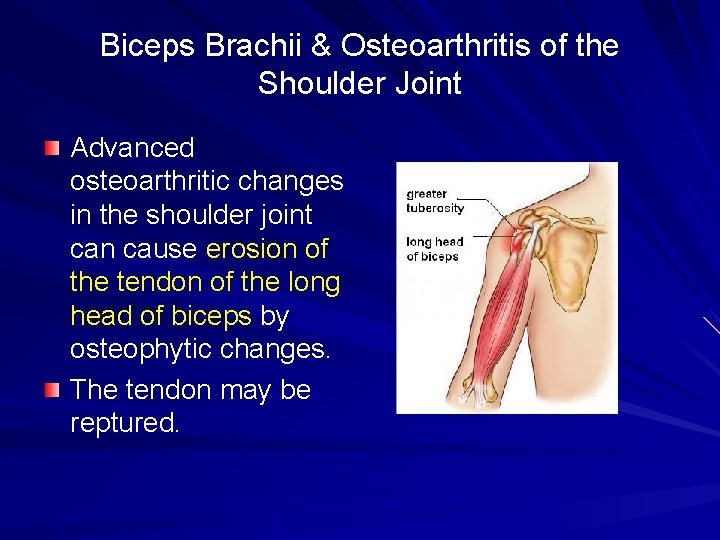 Biceps Brachii & Osteoarthritis of the Shoulder Joint Advanced osteoarthritic changes in the shoulder