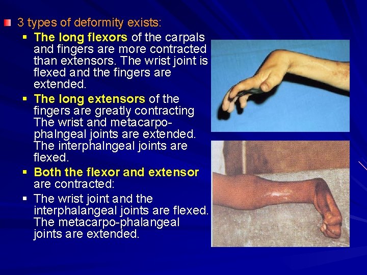 3 types of deformity exists: § The long flexors of the carpals and fingers