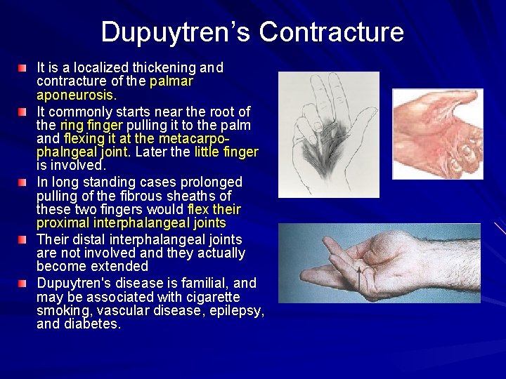Dupuytren’s Contracture It is a localized thickening and contracture of the palmar aponeurosis. It