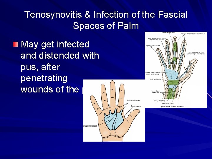 Tenosynovitis & Infection of the Fascial Spaces of Palm May get infected and distended